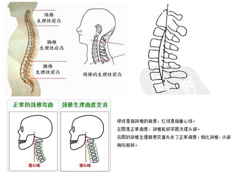 反弓|颈椎反弓怎么治疗和纠正